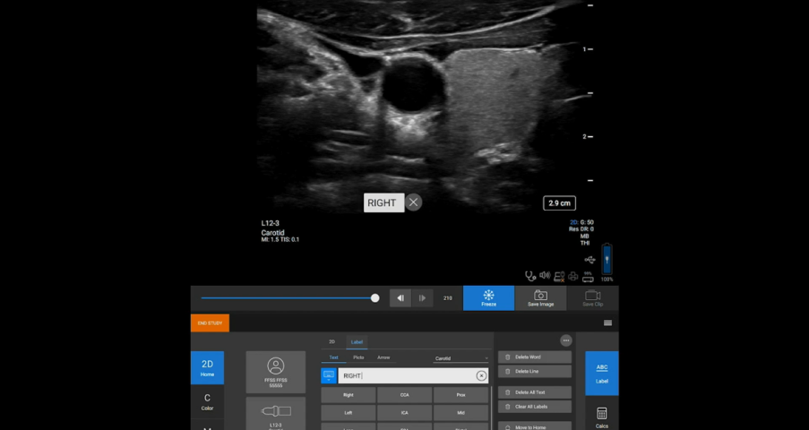 Sonosite ST image on annotating feature