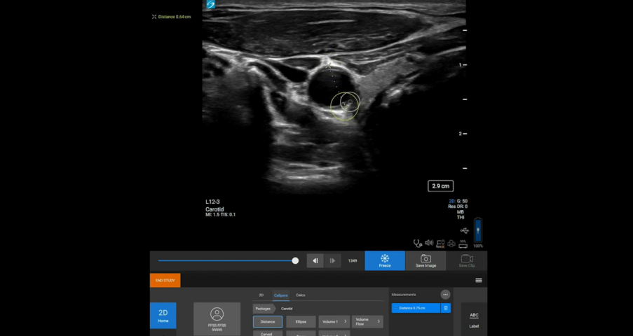 Sonosite ST taking measurement image