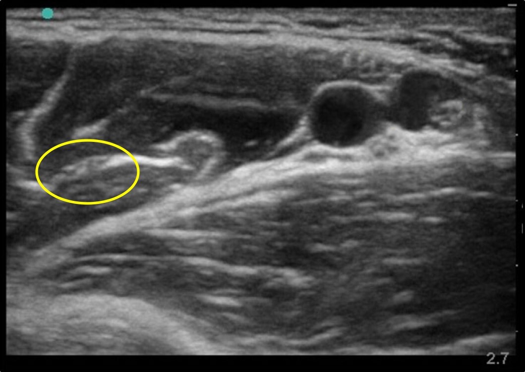 Musculocutaneous Nerve Image 2