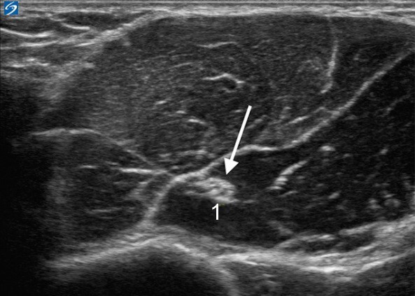 Musculocutaneous Nerve