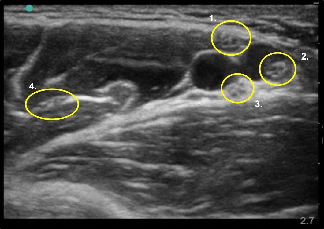 Axillary Nerves