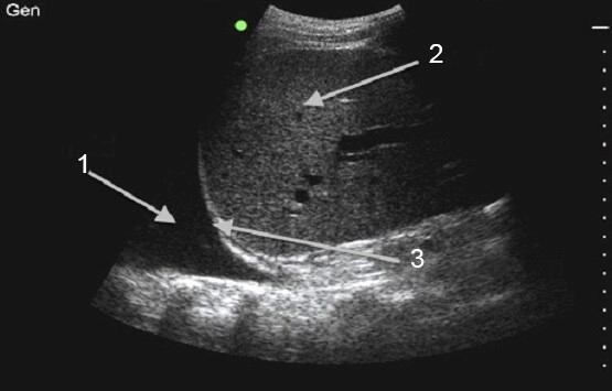 Procedimiento de toracocentesis