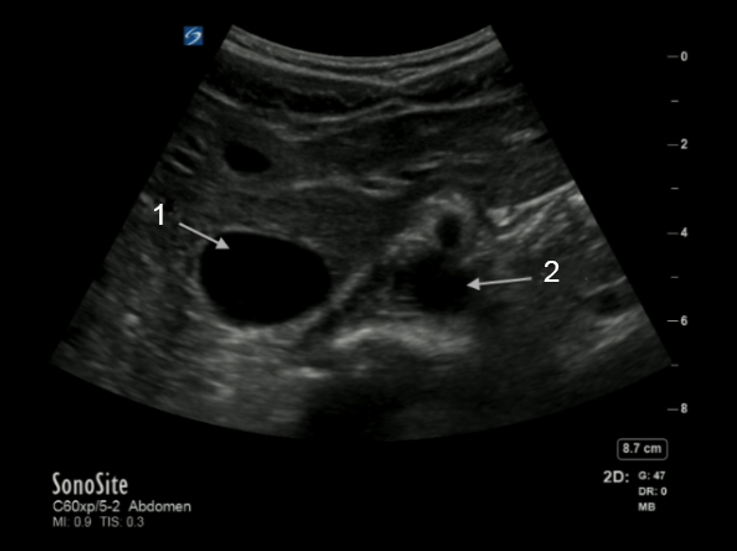 aorta-and-ivc