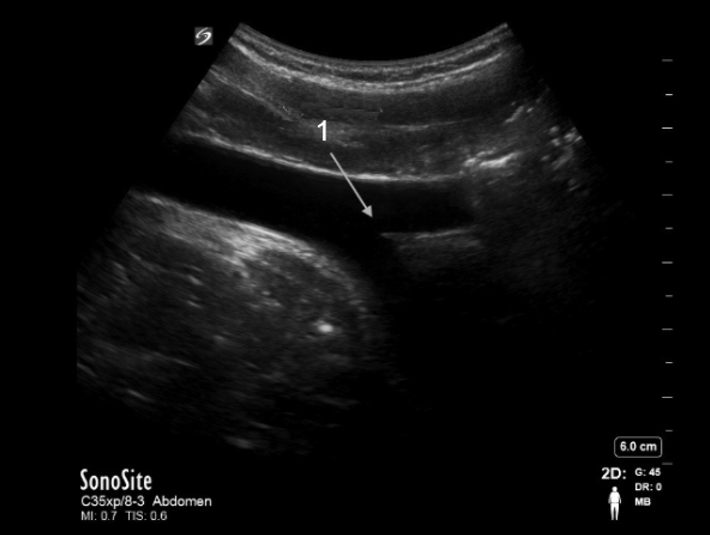 Verzweigung der Aorta, sagittal