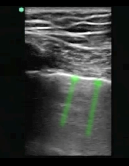 Image Efast Mise En Vidence Des Lignes Pulmonaires Sonosite