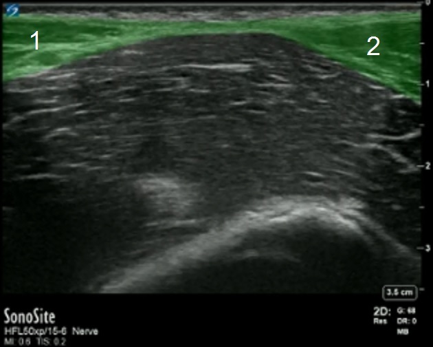 Fascia Iliaca Sartorius Muscle Highlighted Image